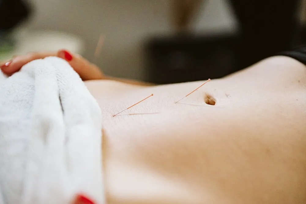 Acupuncture East London